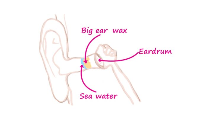 Surfing trouble / Water does not come out of your ears and you cannot hear the sound / The cause may be a large amount of earwax?/Youtube*Browsing attention